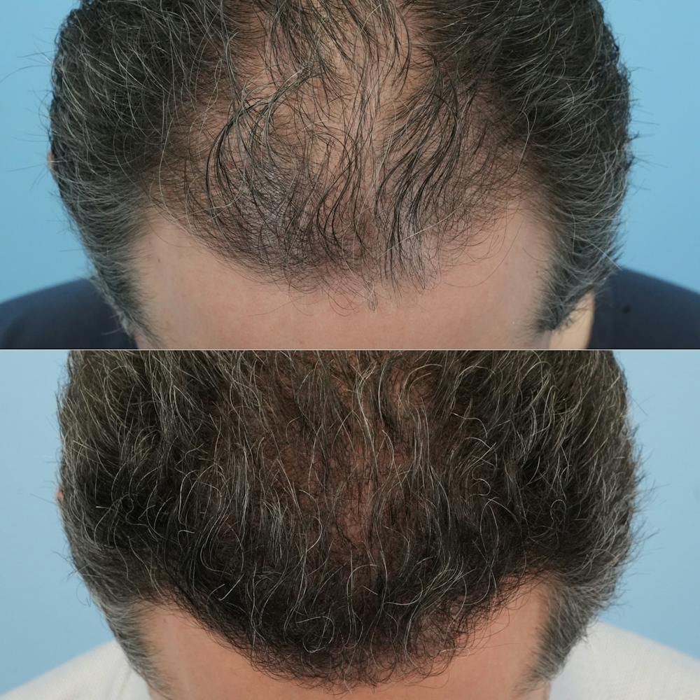 Hair Transplantation Before & After Gallery - Patient 178548 - Image 4