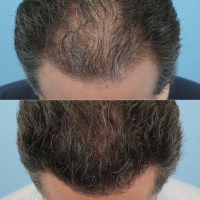 Hair Transplantation Before & After Gallery - Patient 178548 - Image 4