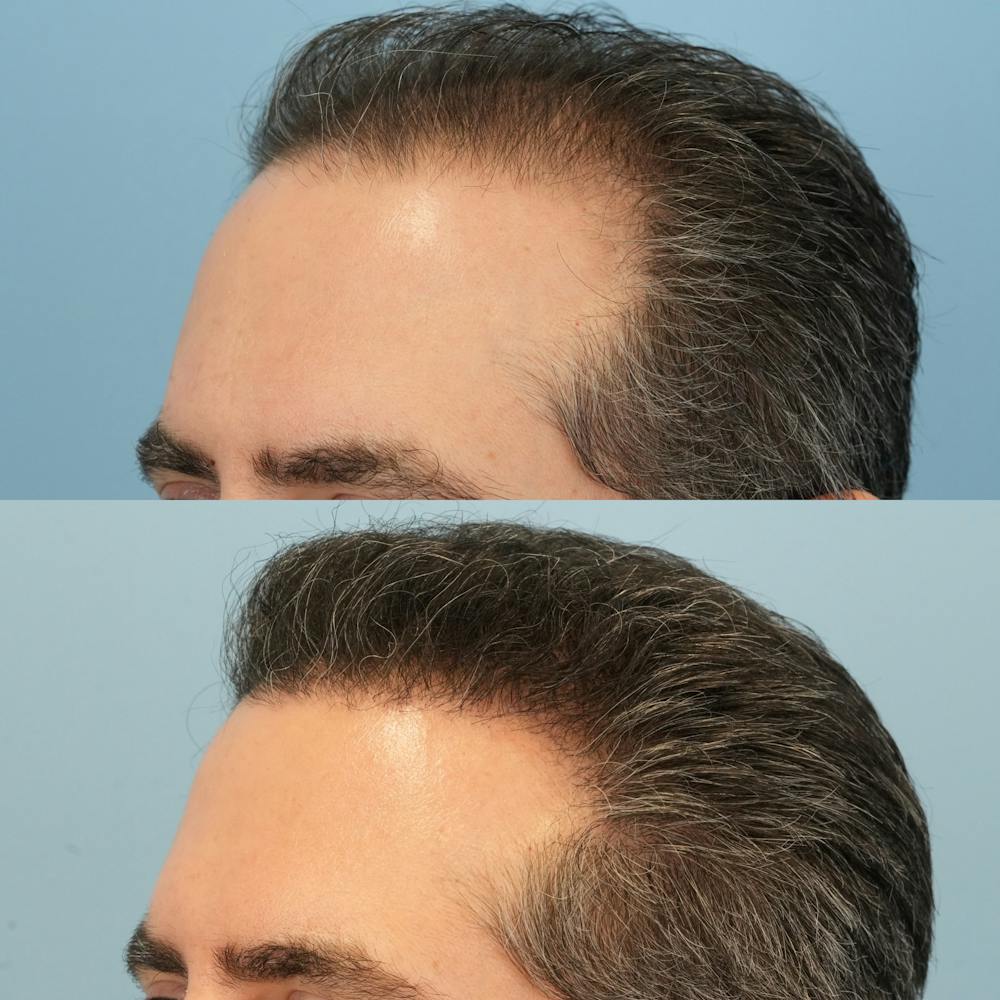 Hair Transplantation Before & After Gallery - Patient 178548 - Image 3