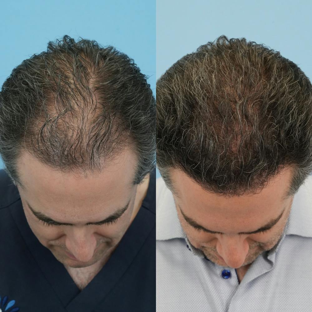Hair Transplantation Before & After Gallery - Patient 178548 - Image 5