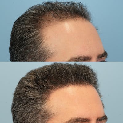 Hair Transplantation Before & After Gallery - Patient 178548 - Image 2