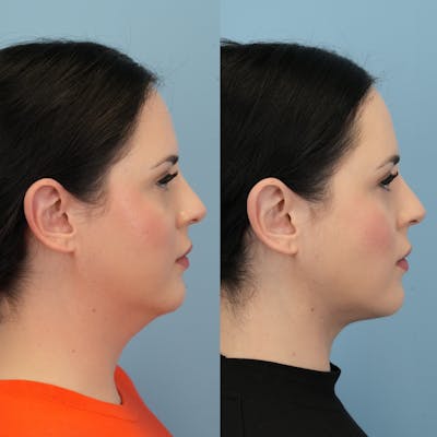 Neck Lift Before & After Gallery - Patient 303633 - Image 1