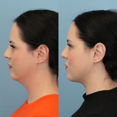 Buccal Fat Excision Before & After Gallery - Patient 419447 - Image 2
