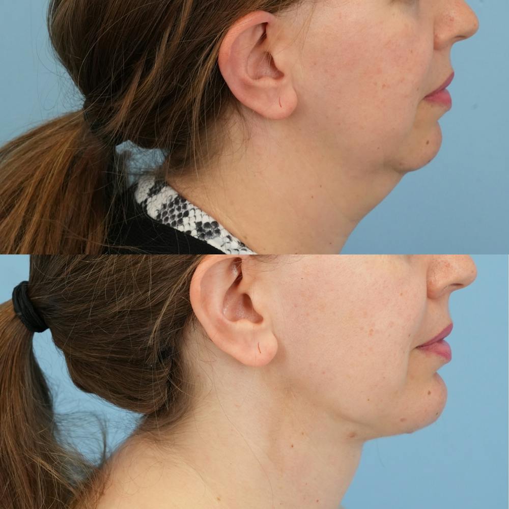Chin Implants Before & After Gallery - Patient 364448 - Image 5