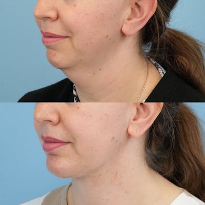 Chin Implants Before & After Gallery - Patient 364448 - Image 2