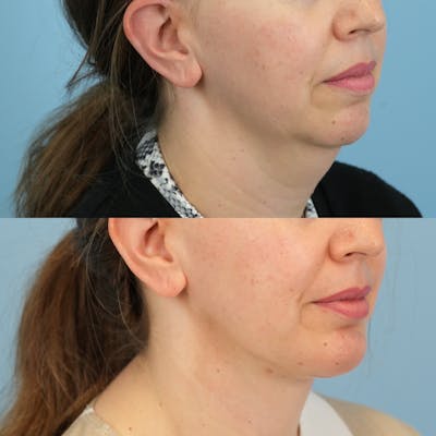 Chin Implants Before & After Gallery - Patient 364448 - Image 4