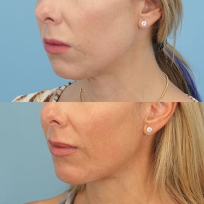 Chin Implants Before & After Gallery - Patient 301790 - Image 2