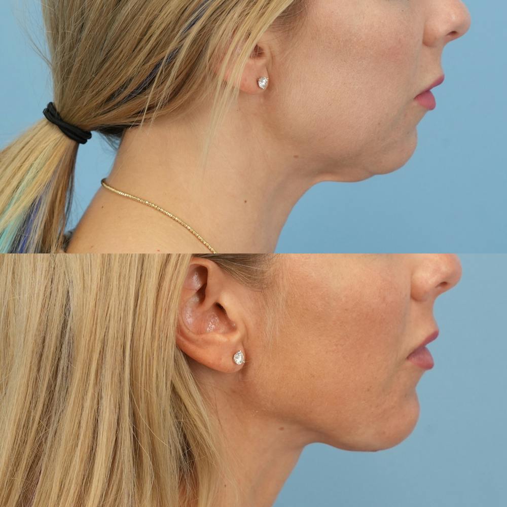 Chin Implants Before & After Gallery - Patient 301790 - Image 5