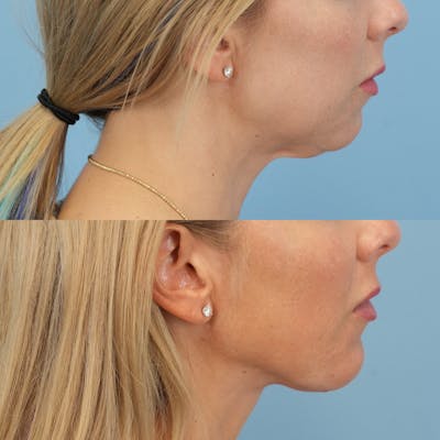 Neck Lift Before & After Gallery - Patient 735501 - Image 1