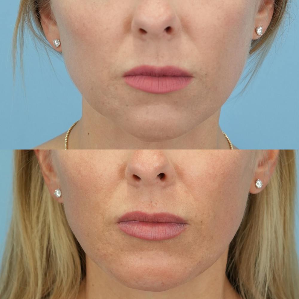 Chin Implants Before & After Gallery - Patient 301790 - Image 3