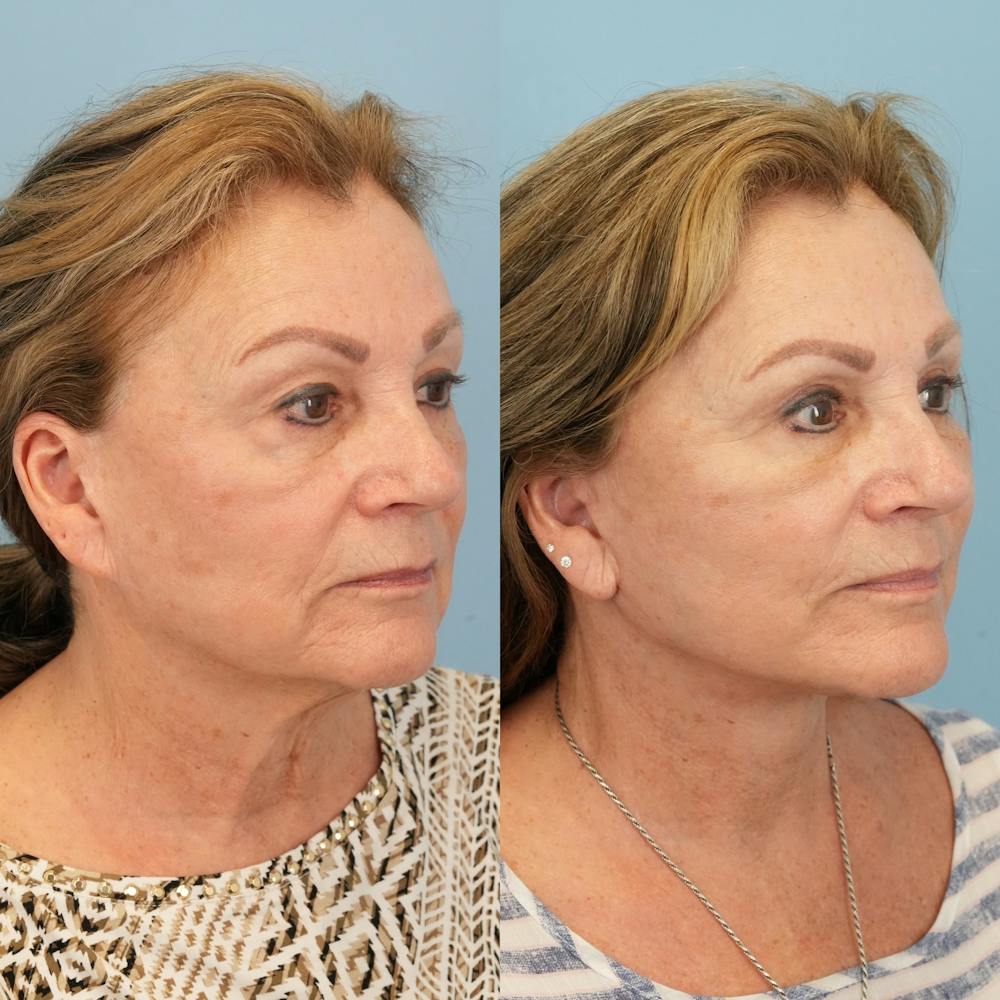 Lower Eyelids Before & After Gallery - Patient 569165 - Image 2