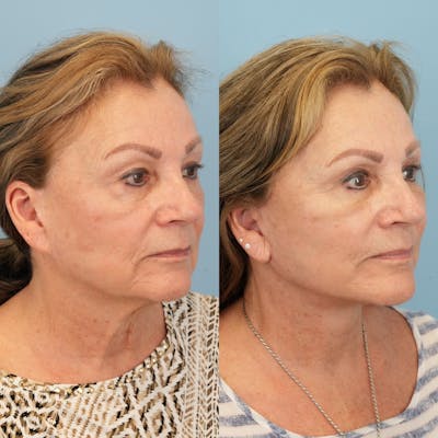 Lower Eyelids Before & After Gallery - Patient 569165 - Image 2