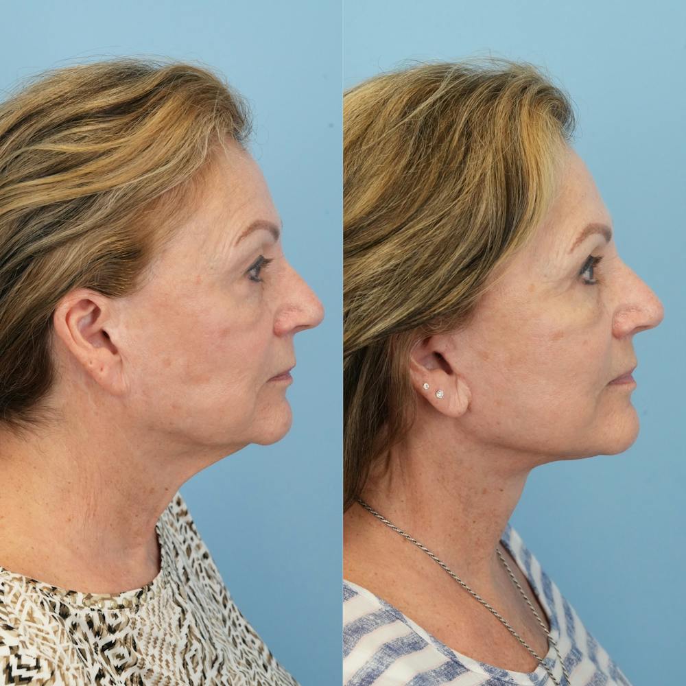 Lower Eyelids Before & After Gallery - Patient 569165 - Image 3