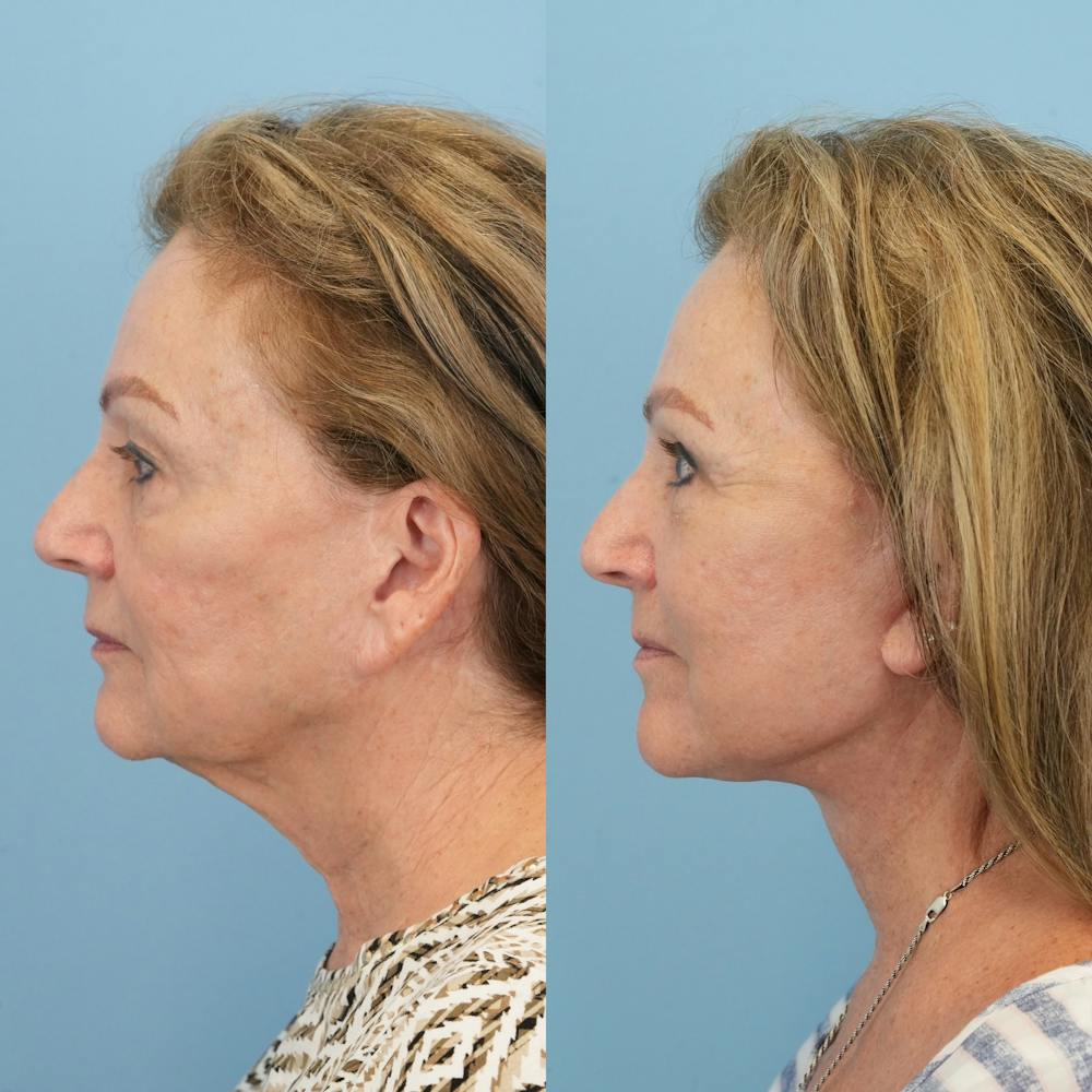 Lower Eyelids Before & After Gallery - Patient 569165 - Image 5