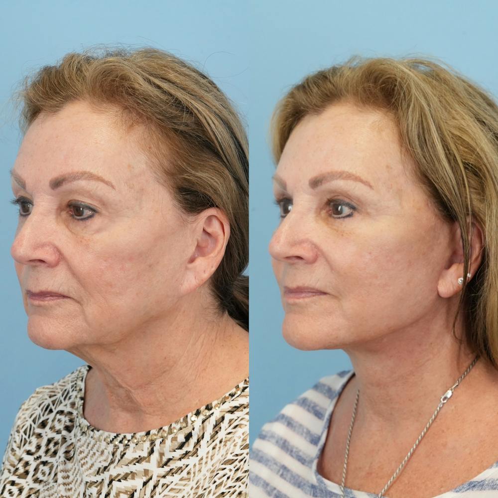 Lower Eyelids Before & After Gallery - Patient 569165 - Image 4