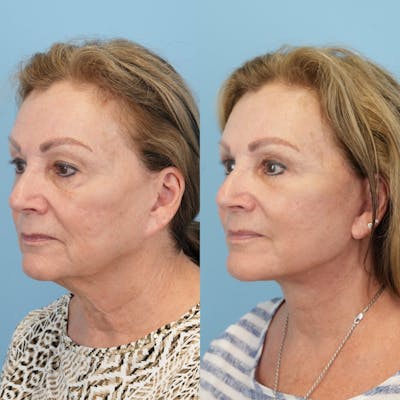 Lower Eyelids Before & After Gallery - Patient 569165 - Image 4