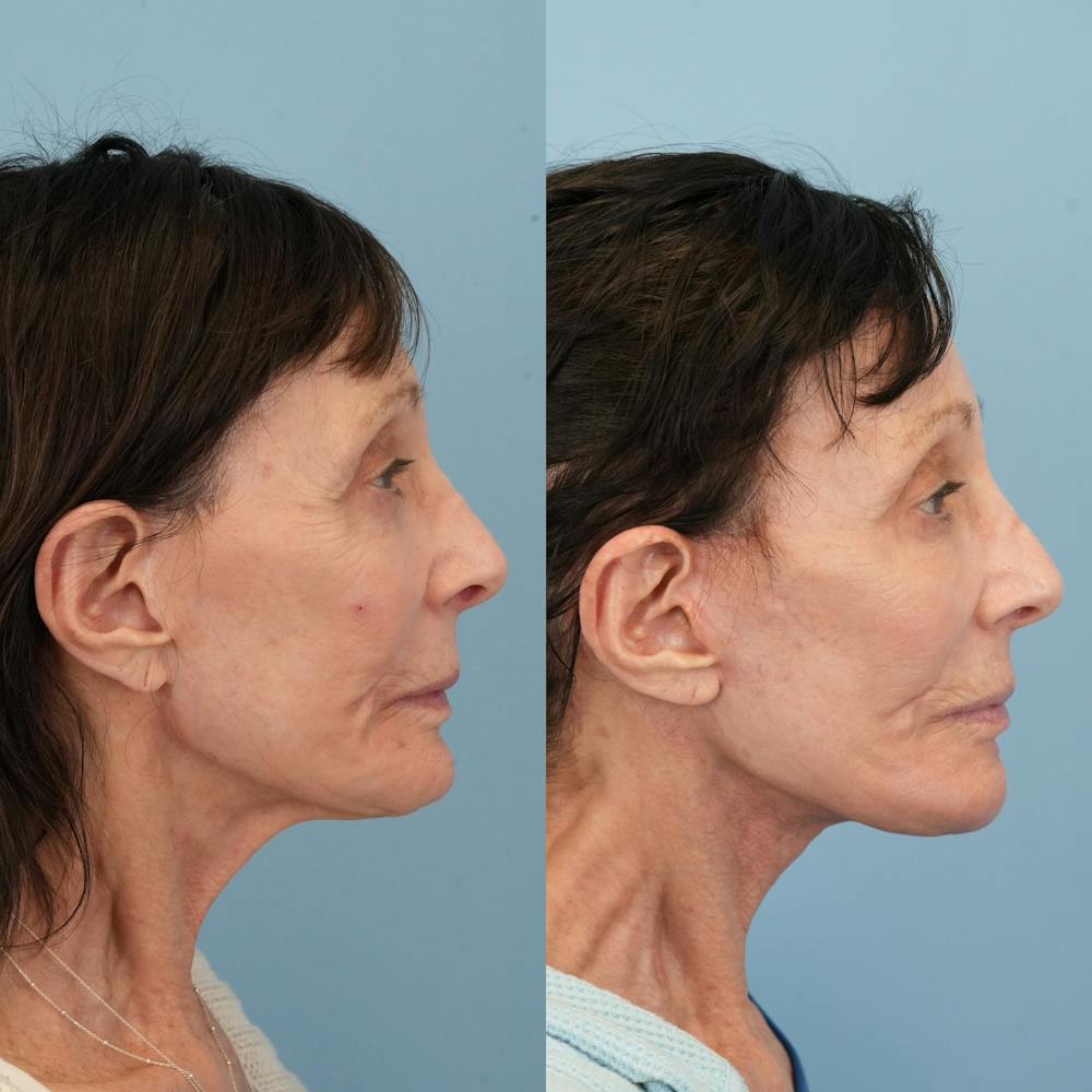 Chin Implants Before & After Gallery - Patient 183380 - Image 9