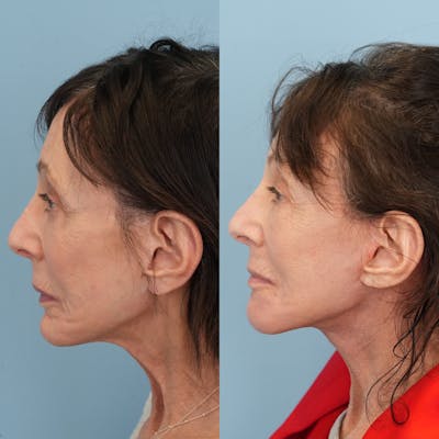 Chin Implants Before & After Gallery - Patient 183380 - Image 2