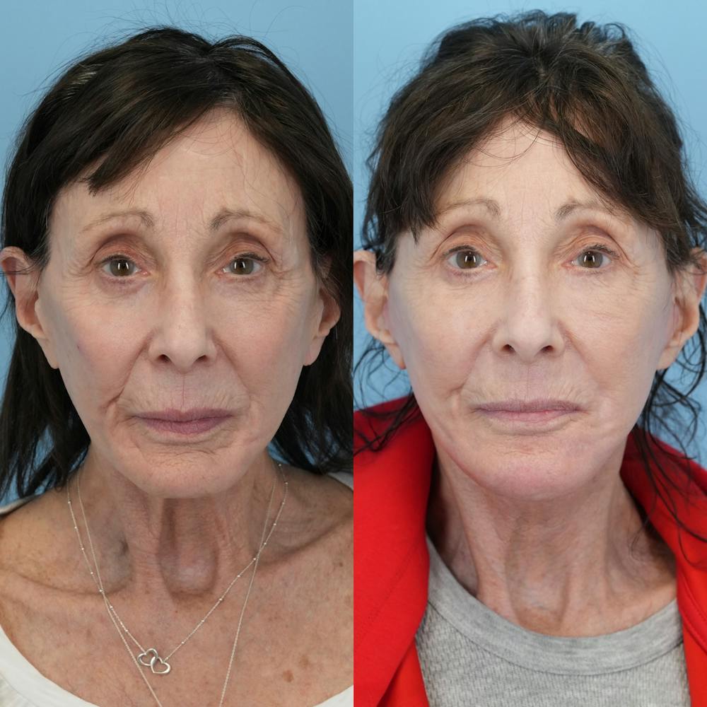 Chin Implants Before & After Gallery - Patient 183380 - Image 6