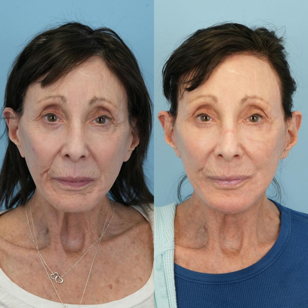Chin Implants Before & After Gallery - Patient 183380 - Image 5