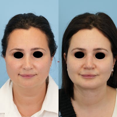 Rhinoplasty Before & After Gallery - Patient 408603 - Image 1