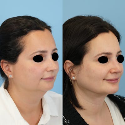 Rhinoplasty Before & After Gallery - Patient 408603 - Image 2