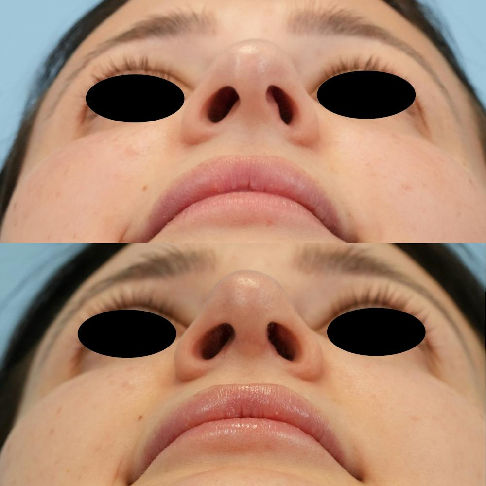 Rhinoplasty Before & After Gallery - Patient 408603 - Image 6