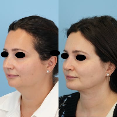 Rhinoplasty Before & After Gallery - Patient 408603 - Image 4