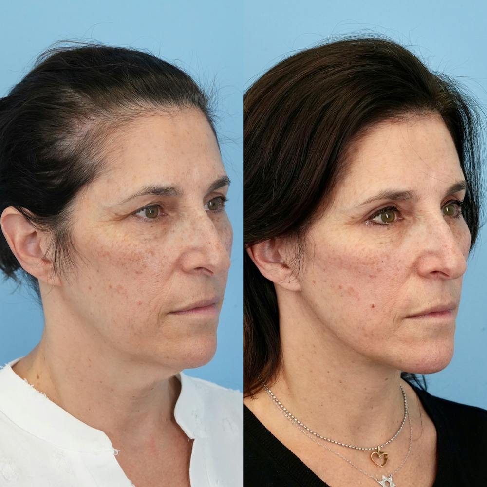 Lower Eyelids Before & After Gallery - Patient 817881 - Image 2