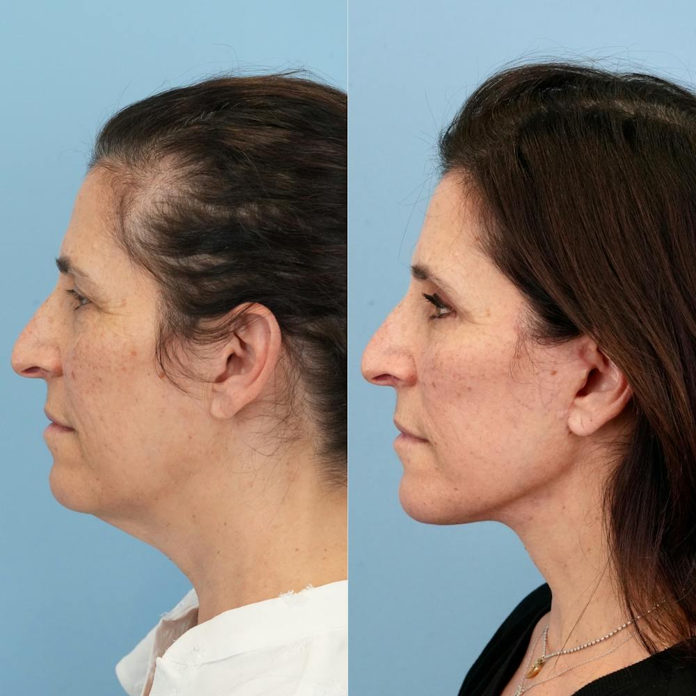 Lower Eyelids Before & After Gallery - Patient 817881 - Image 5