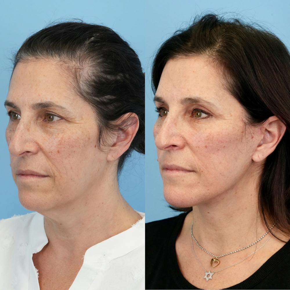 Lower Eyelids Before & After Gallery - Patient 817881 - Image 4