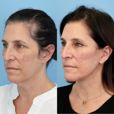 Lower Eyelids Before & After Gallery - Patient 817881 - Image 4