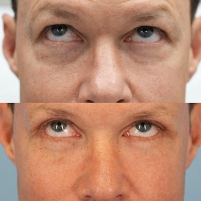 Lower Eyelids Before & After Gallery - Patient 221604 - Image 2