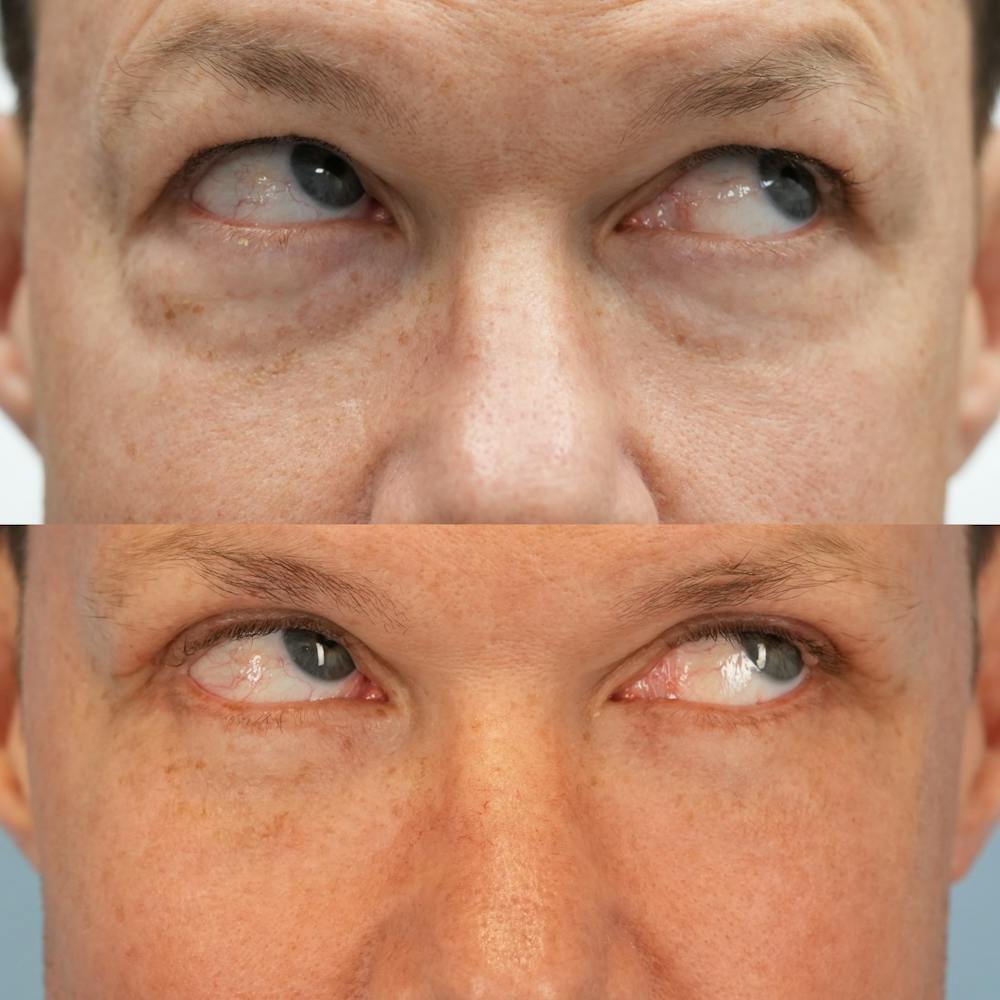 Lower Eyelids Before & After Gallery - Patient 221604 - Image 4
