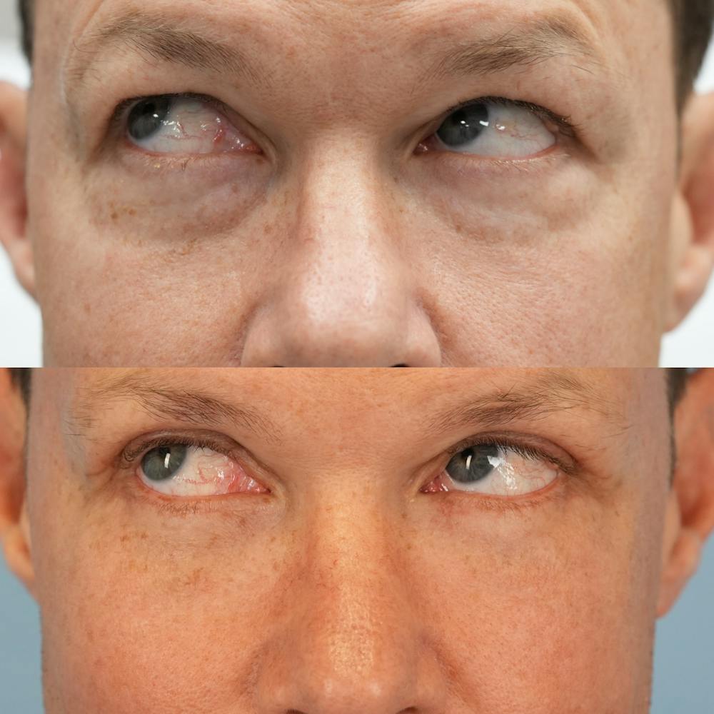 Lower Eyelids Before & After Gallery - Patient 221604 - Image 5
