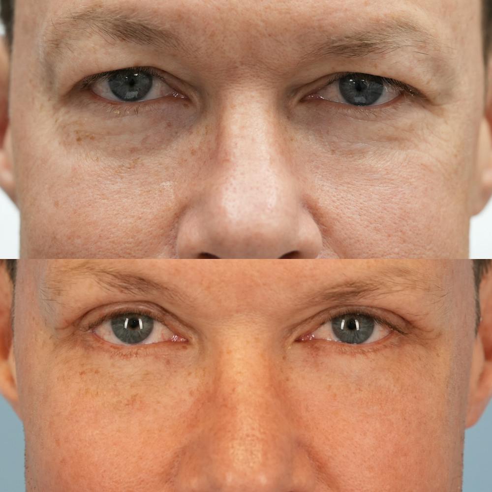 Lower Eyelids Before & After Gallery - Patient 221604 - Image 1
