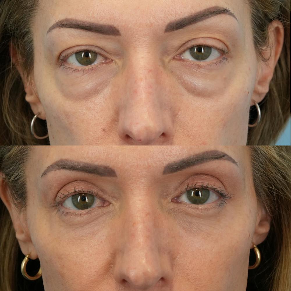 Lower Eyelids Before & After Gallery - Patient 323531 - Image 1