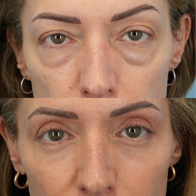 Lower Eyelids Before & After Gallery - Patient 323531 - Image 1
