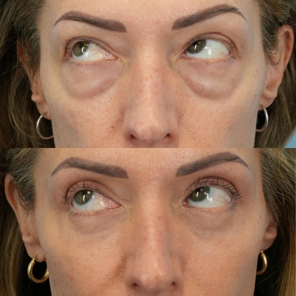 Lower Eyelids Before & After Gallery - Patient 323531 - Image 5