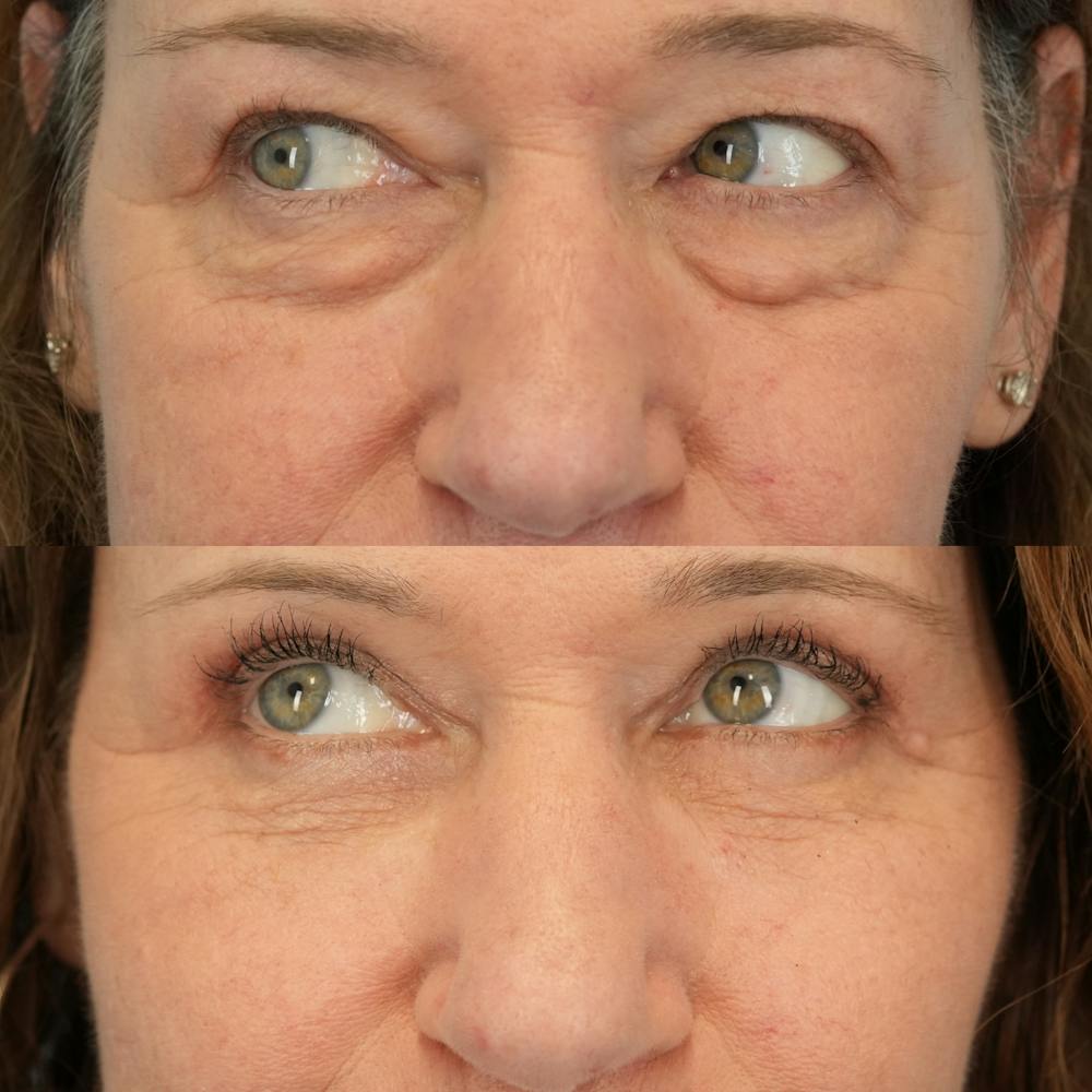 Lower Eyelids Before & After Gallery - Patient 398516 - Image 5