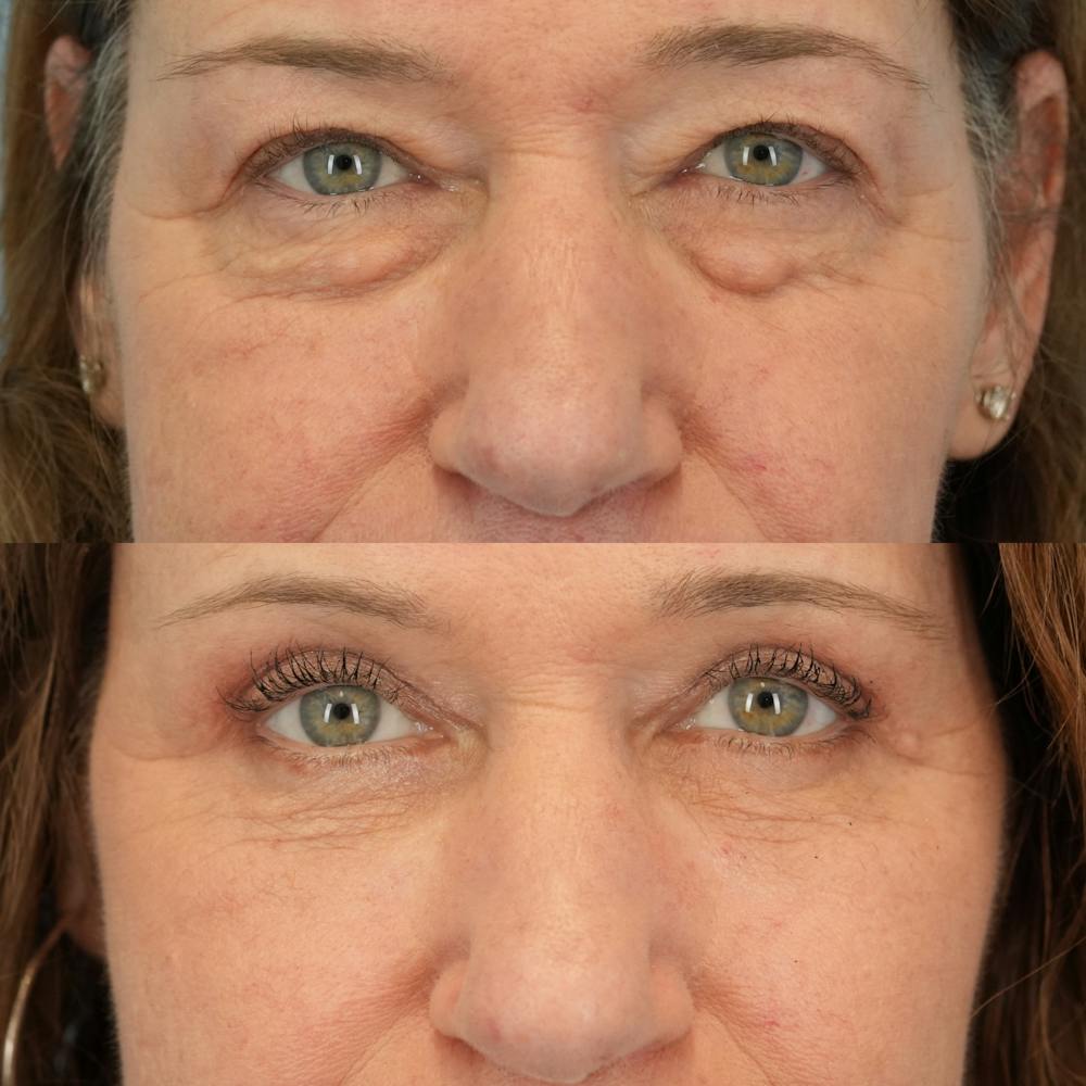 Lower Eyelids Before & After Gallery - Patient 398516 - Image 1
