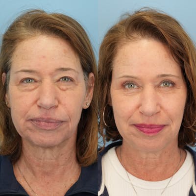 Lower Eyelids Before & After Gallery - Patient 398516 - Image 6