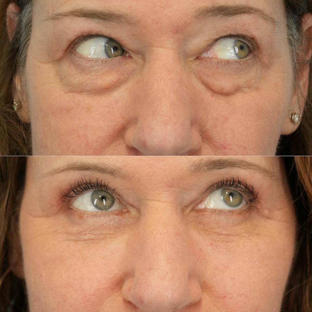 Lower Eyelids Before & After Gallery - Patient 398516 - Image 4
