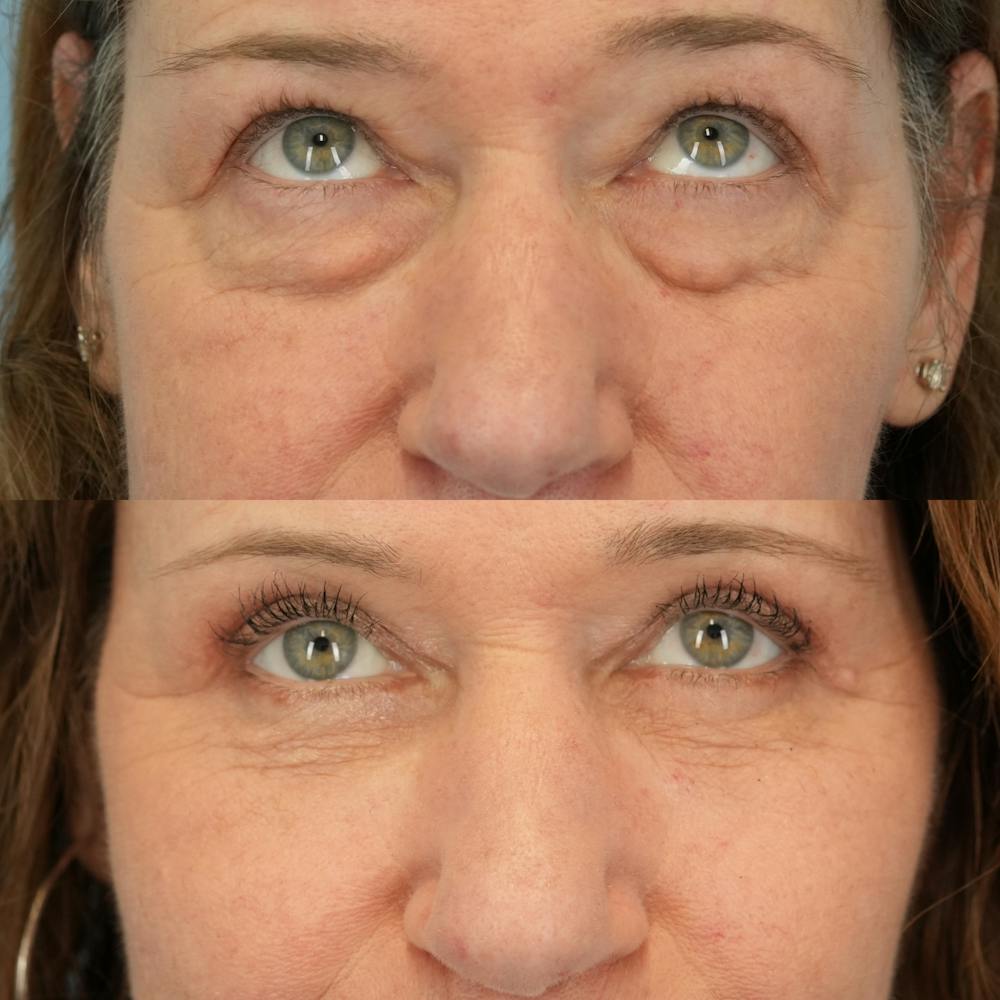 Lower Eyelids Before & After Gallery - Patient 398516 - Image 2