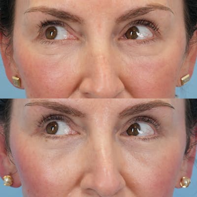 Lower Eyelids Before & After Gallery - Patient 267720 - Image 4
