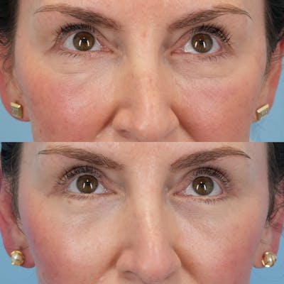 Lower Eyelids Before & After Gallery - Patient 267720 - Image 2