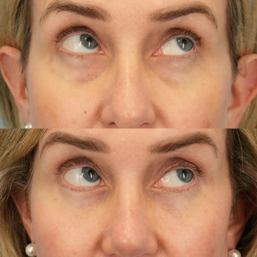 Lower Eyelids Before & After Gallery - Patient 226077 - Image 4