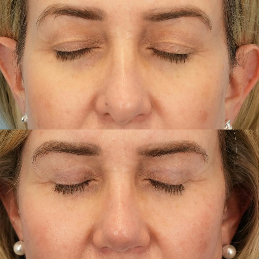 Lower Eyelids Before & After Gallery - Patient 226077 - Image 3