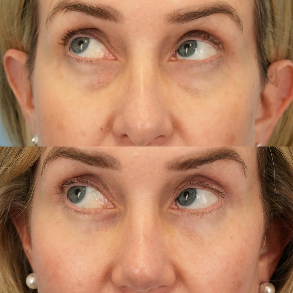 Lower Eyelids Before & After Gallery - Patient 226077 - Image 5