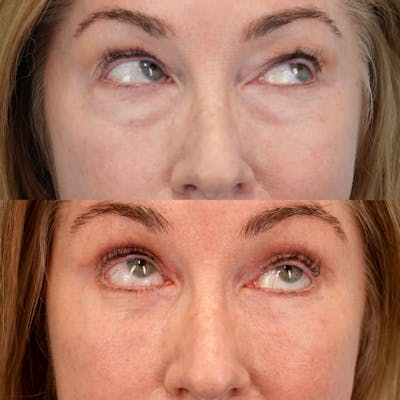 Lower Eyelids Before & After Gallery - Patient 547279 - Image 4